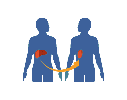 Transplant Surgeries